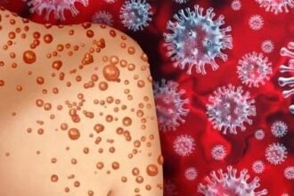 mpoxxx Jangan Keluar Negeri Dulu, Thailand Laporkan Kasus Pertama Mpox Klade 1b yang Lebih Berbahaya