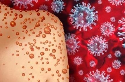 Jangan Keluar Negeri Dulu, Thailand Laporkan Kasus Pertama Mpox Klade 1b yang Lebih Berbahaya