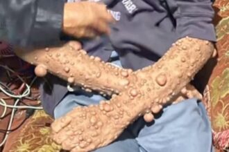 IMG 20250827 WA0010 Kisah Abdurrohman, Penderita Penyakit Kulit Genetik di Sukabumi yang Akhirnya Dapat Penanganan