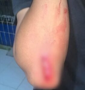 Korban gerombolan bersajam memperlihatkan bagian lengannya yang terluka. (Prima Arno/Terlusurbisnis)